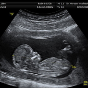 ultrasound-image-of-baby