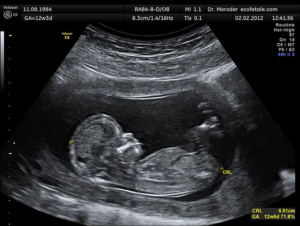 12-week-ultrasound